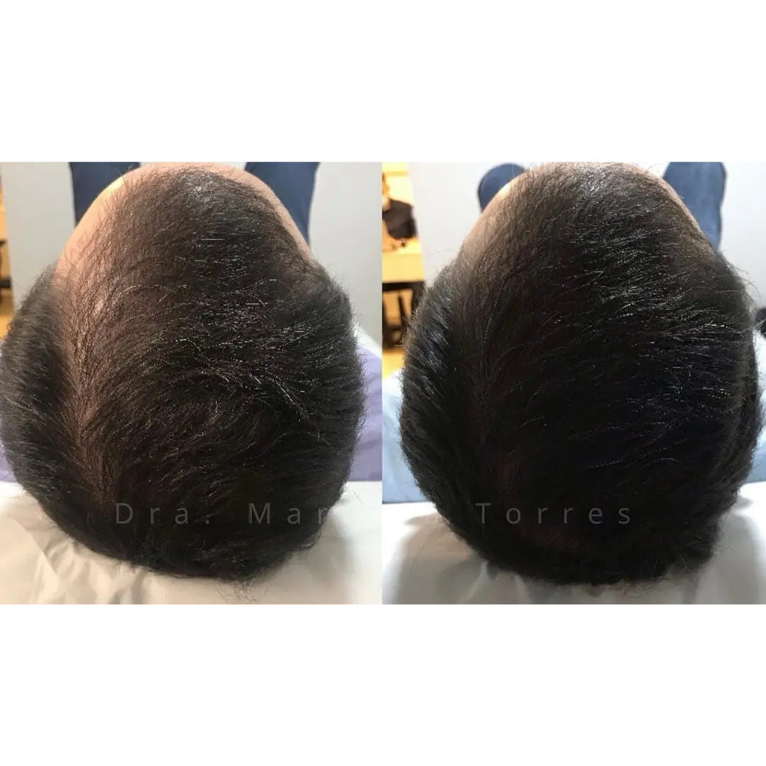 alopecea-tratamento