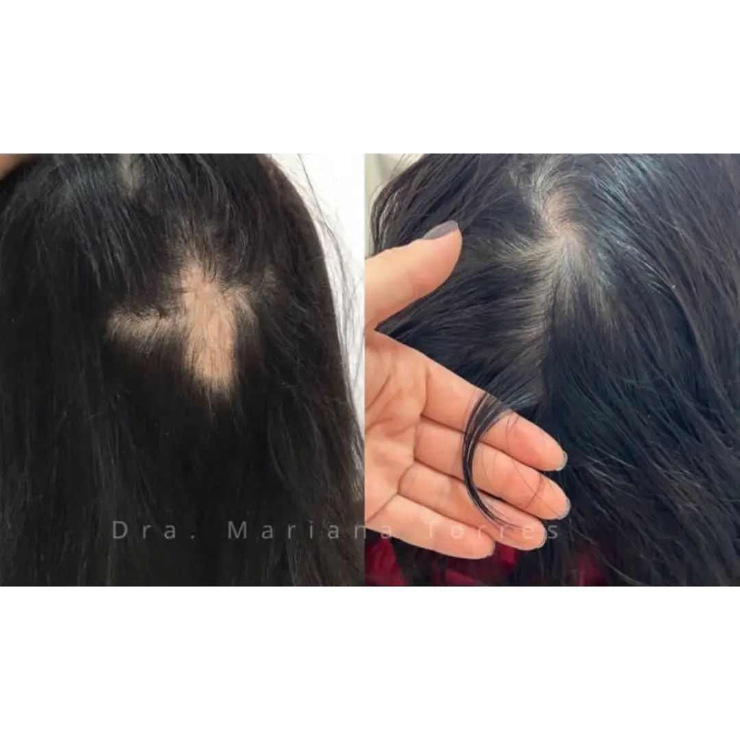 alopecea-tratar
