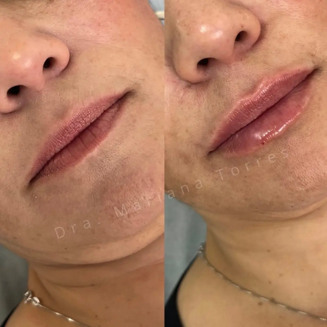 harmonizaçao facial boca