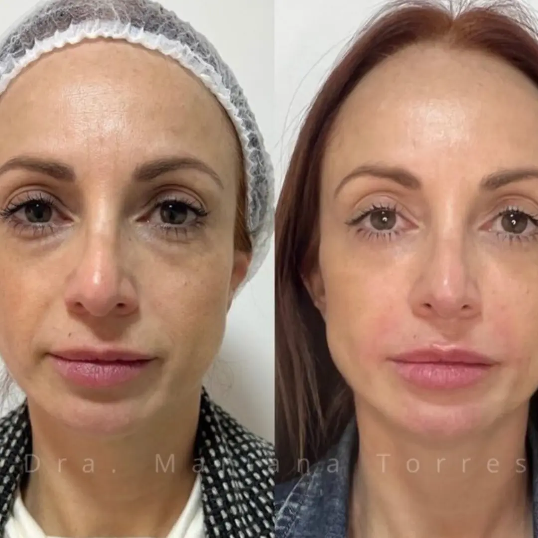 harmonizaçao facial em moema