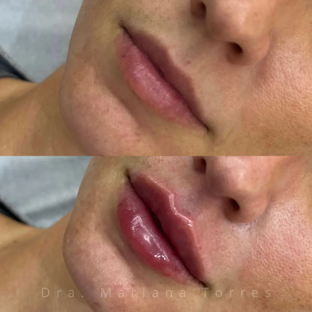 harmonizaçao facial labios
