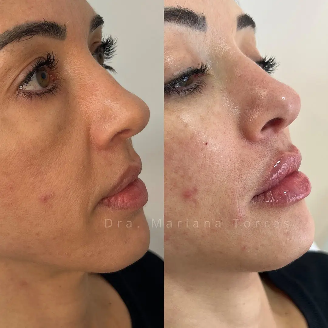 harmonizaçao facial moliere moema
