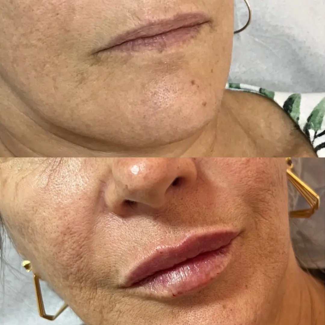 harmonizaçao facial na boca
