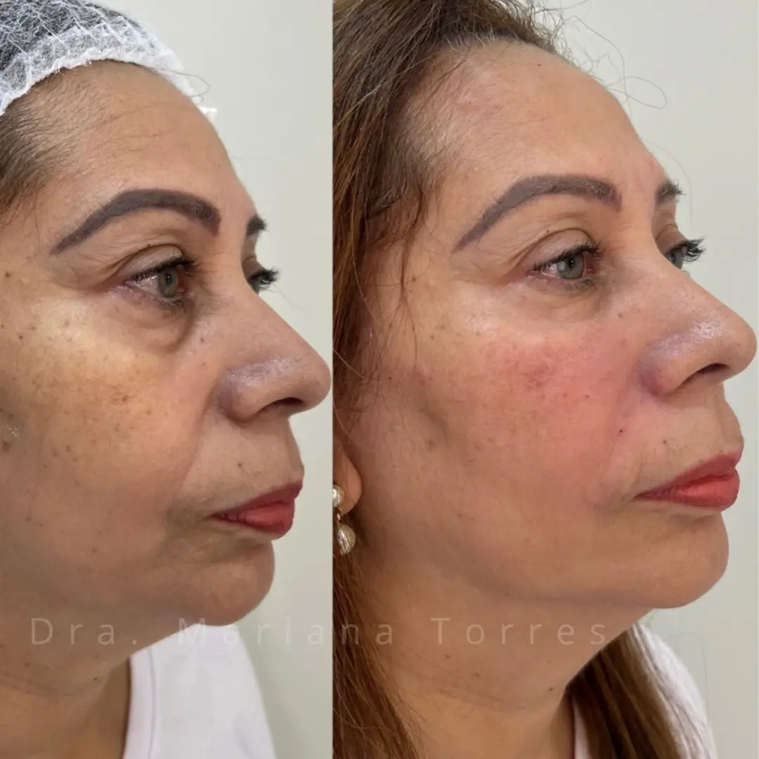 harmonizaçao facial na moliere