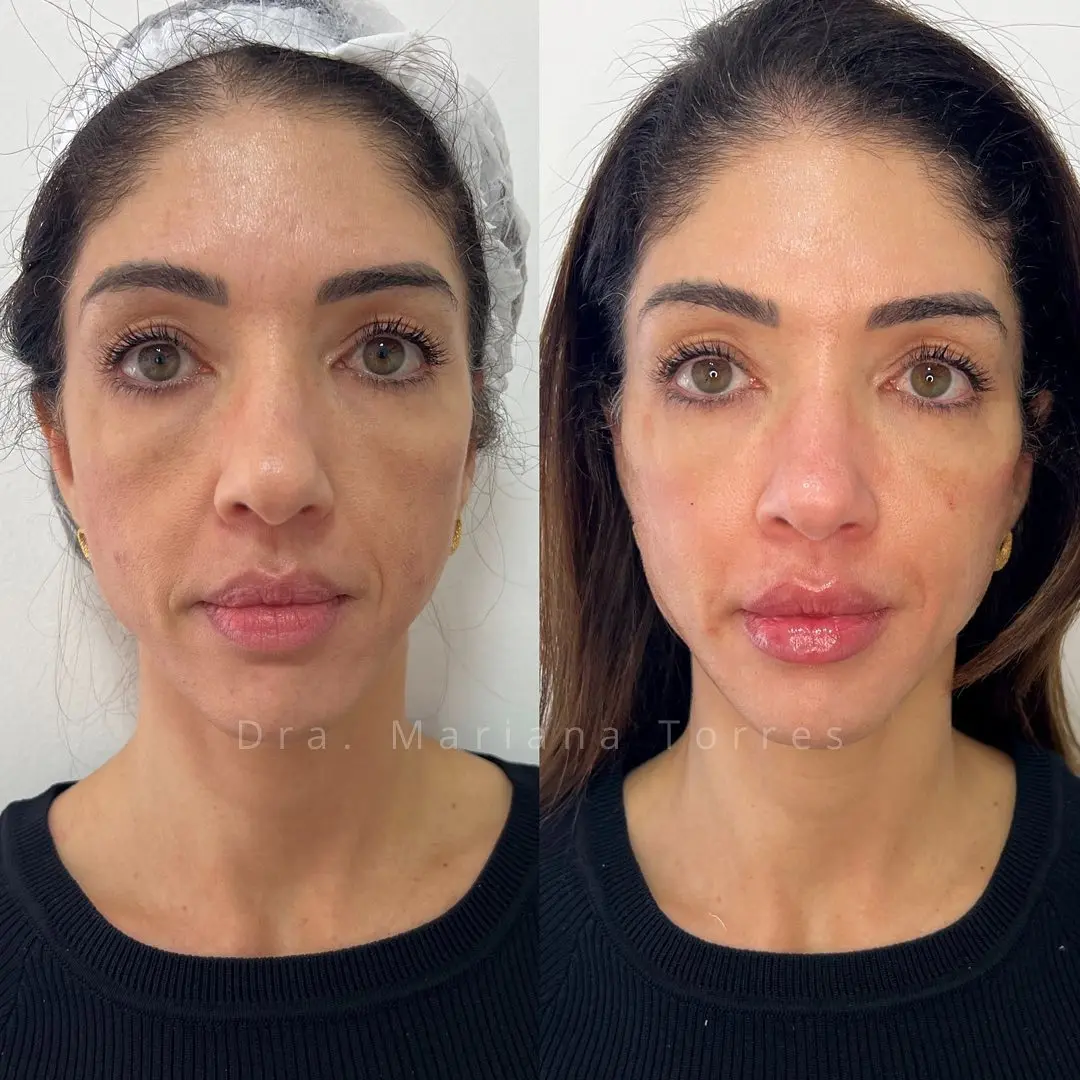 harmonizaçao facial personalizada