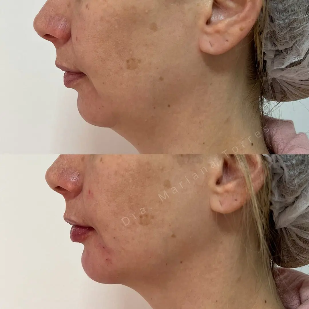 harmonizaçao facial