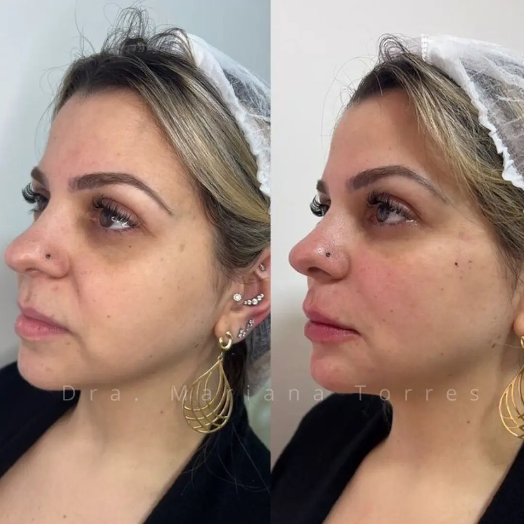 harmonizaçao facialmoliere