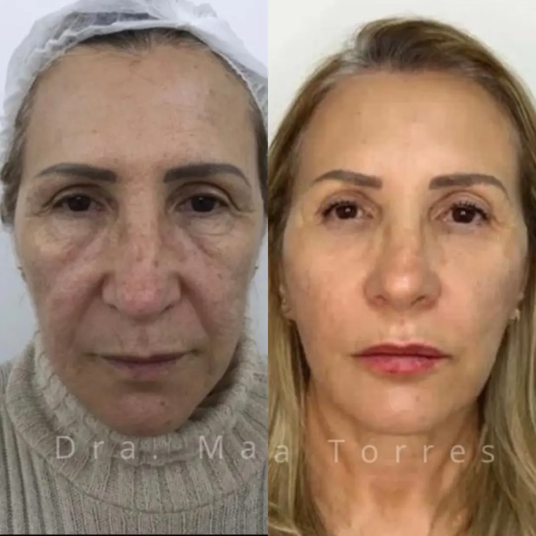 moliere-rejuvenescimento-facial