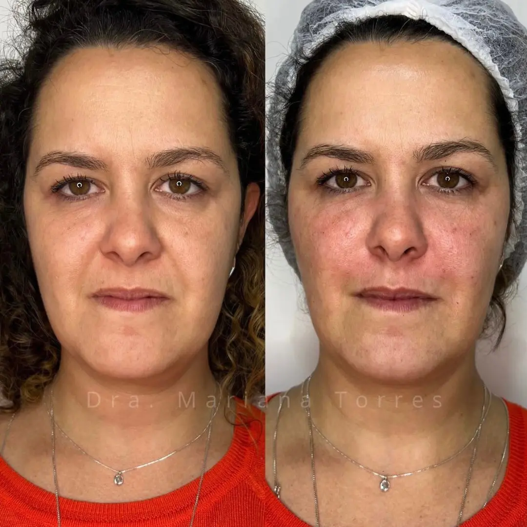 rejuvenescimento facial