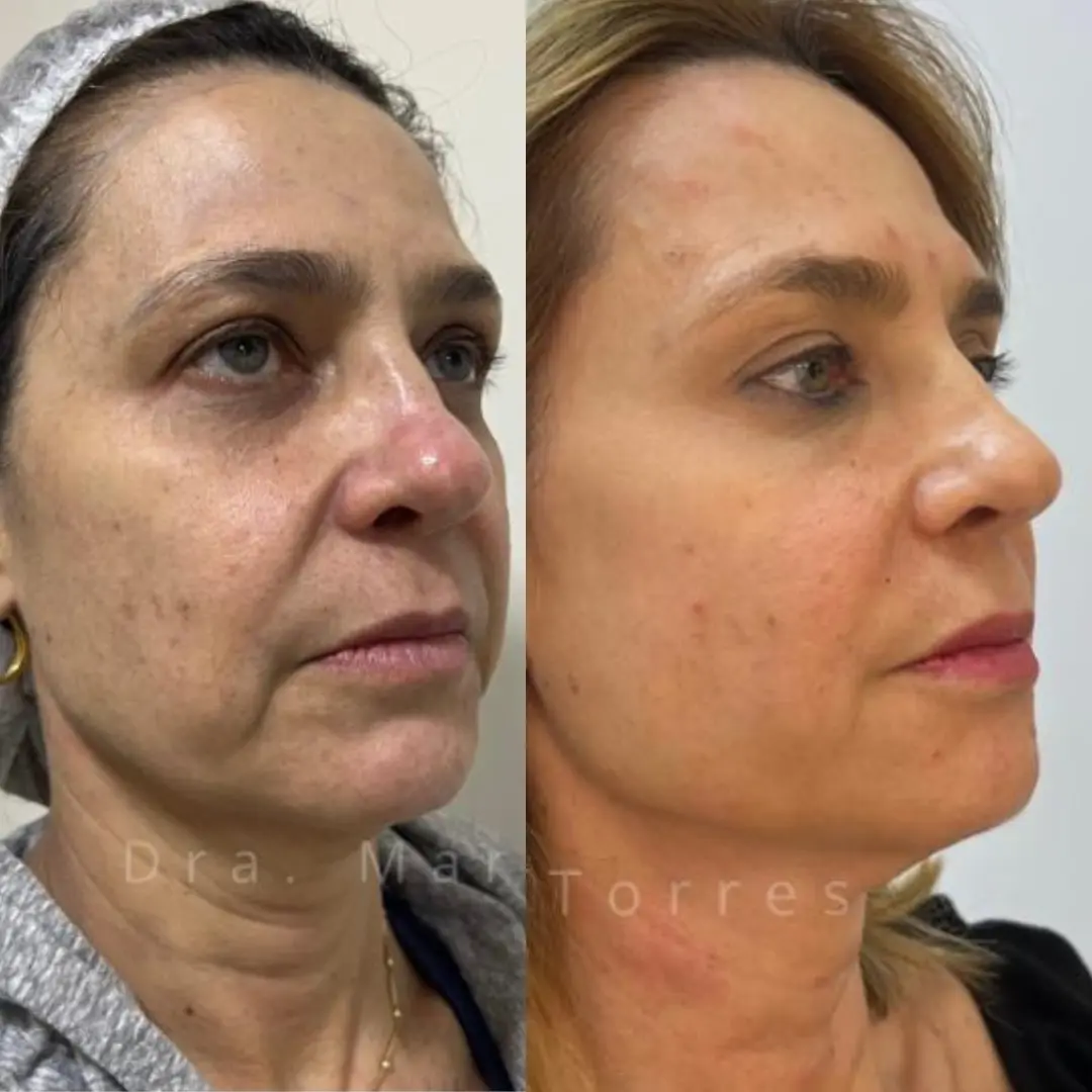 tratamento-facial-moliere