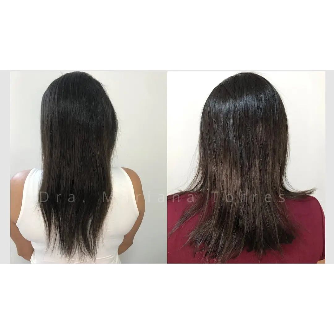 tratar alopecea